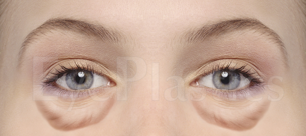 Lower eyelid blepharoplasty before and after