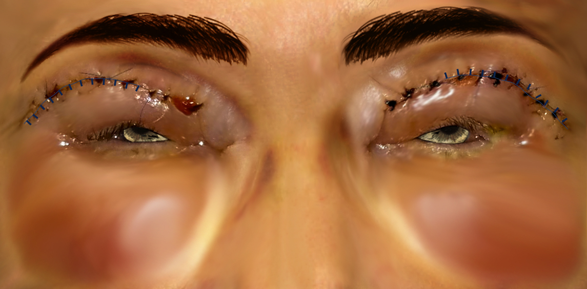 Upper blepharoplasty recovery at day 2