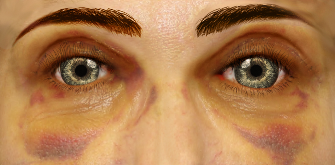Upper blepharoplasty recovery at 3 weeks