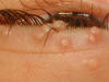 Molluscum contagiosum &mdash; close-up of eyelid papules